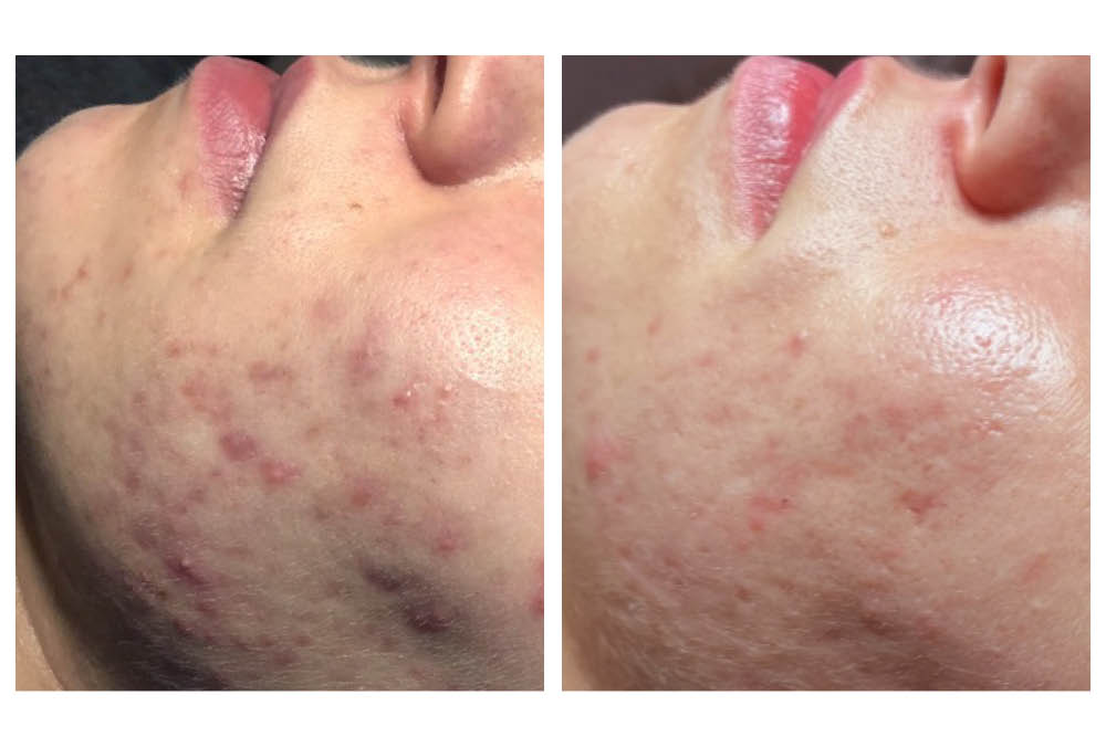 SQT voor en na acne blog SQT bio-microneedling behandeling acne