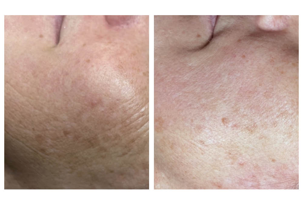 Nieuw SQT bio-microneedling!